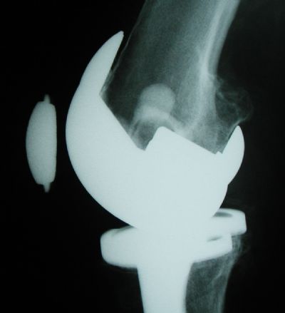 Zimmer Patella Prosthesis (Implant 401)